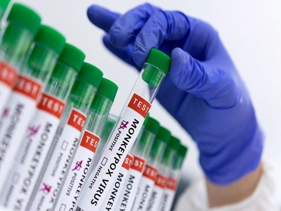 Monkeypox suspect undergoes test, report awaited: Karnataka Health minister 1 Monkeypox