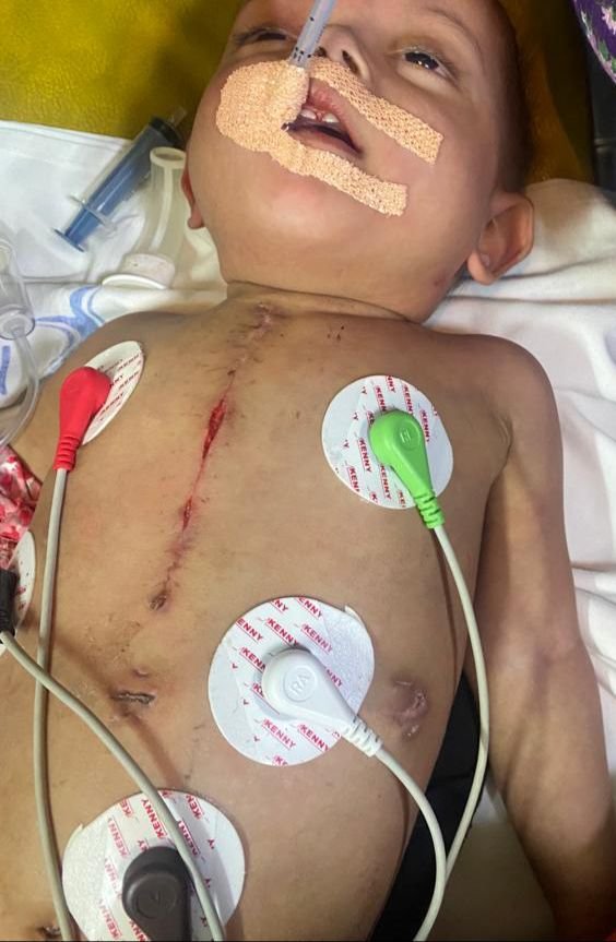 14-month-old attended by doctors onboard Vistara flight for heart ailment ‘in critical stage on ventilator’ say hospital 1 14-month-old attended by doctors onboard Vistara flight for heart ailment ‘in critical stage on ventilator’ say hospital